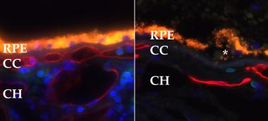 Labeling of healthy blood vessels (red) in a healthy eye (left) and an eye with geographic atrophy (right). Note the loss of choriocapillaris vessels (CC) in the eye with geographic atrophy. Labeling of healthy blood vessels (red) in a healthy eye (left) and an eye with geographic atrophy (right). Note the loss of choriocapillaris vessels (CC) in the eye with geographic atrophy.